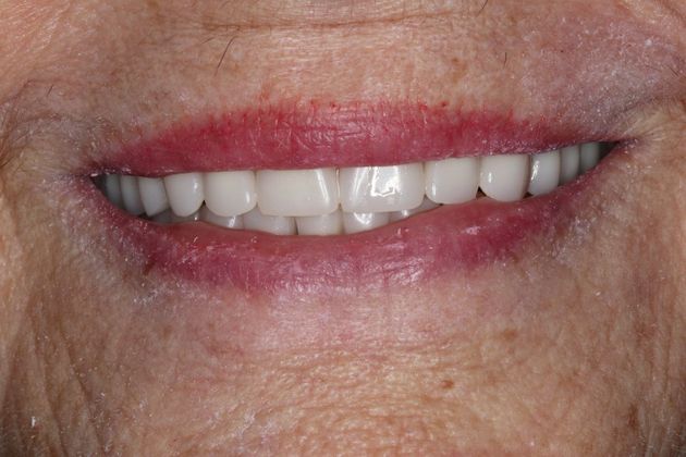 Dentures: Case 9 - After