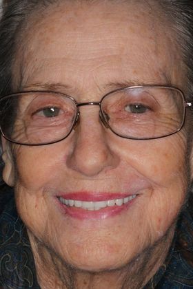 Dentures Case 9 - After