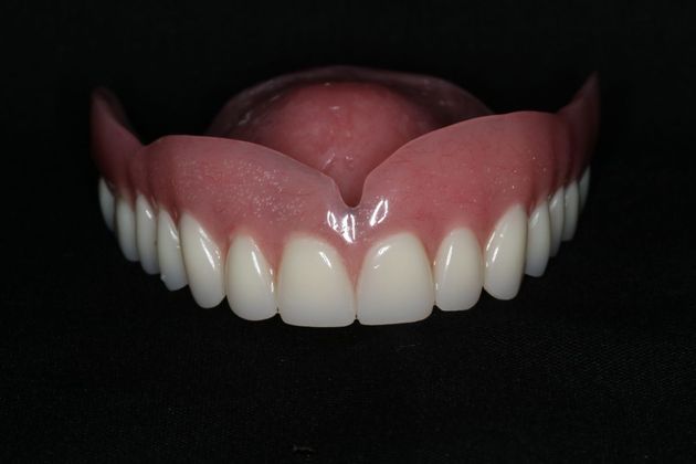 Dentures: Case 9 - Upper Denture