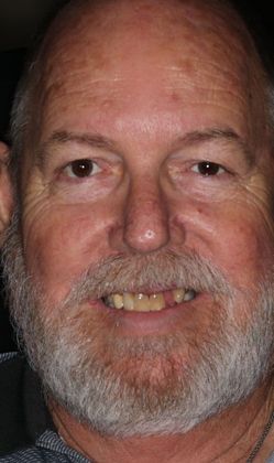 Full Mouth Reconstruction Case 5 - Before