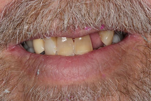 Full Mouth Reconstruction: Case 5 - Before