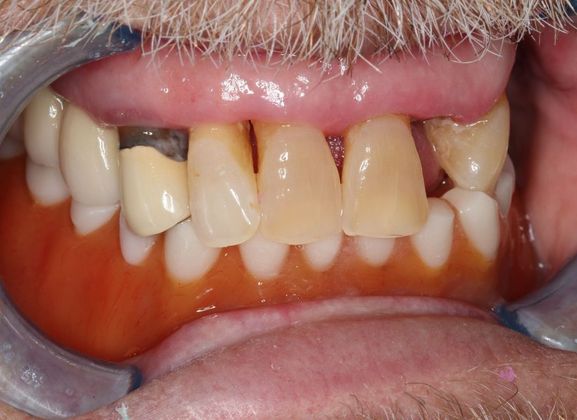Full Mouth Reconstruction: Case 5 - Before