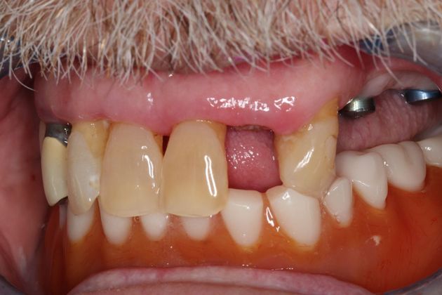 Full Mouth Reconstruction: Case 5 - Before