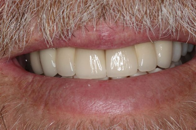 Full Mouth Reconstruction: Case 5 - After