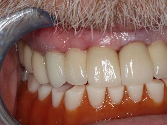 Full Mouth Reconstruction: Case 5 - After