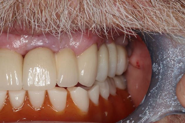 Full Mouth Reconstruction: Case 5 - After