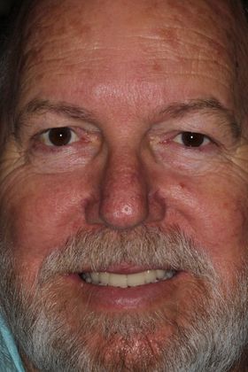 Dental Implants Case 8 - After