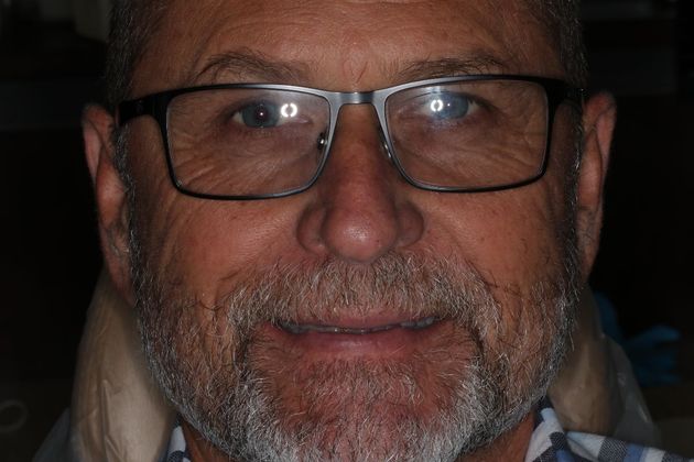 Full Mouth Reconstruction Case 6 - Before