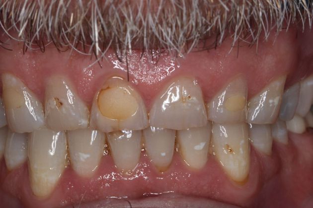 Full Mouth Reconstruction: Case 6 - Before