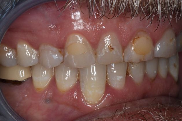 Full Mouth Reconstruction: Case 6 - Before