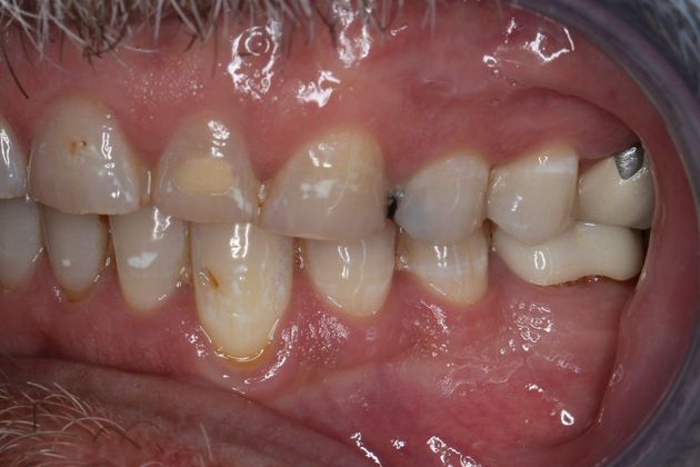 Full Mouth Reconstruction: Case 6 - Before
