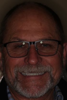 Full Mouth Reconstruction Case 6 - After