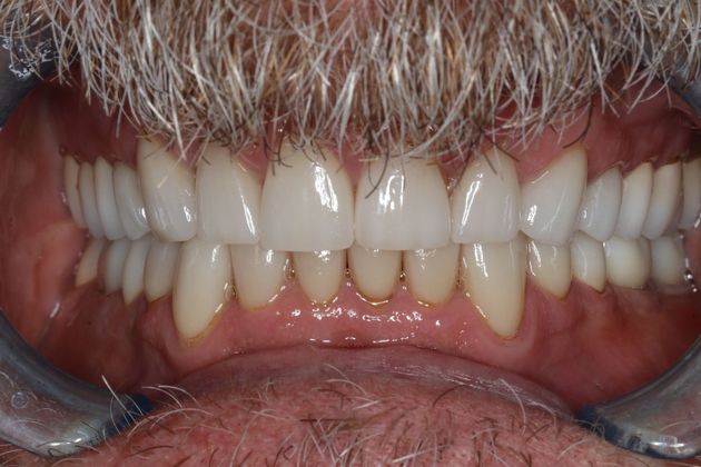 Full Mouth Reconstruction: Case 6 - After