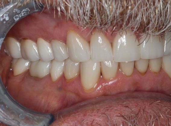 Full Mouth Reconstruction: Case 6 - After