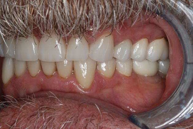 Full Mouth Reconstruction: Case 6 - After