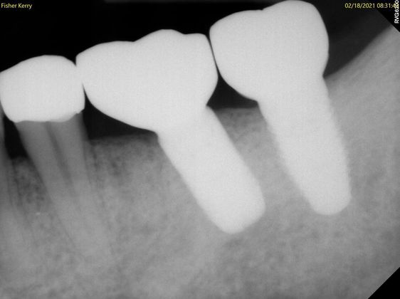 Dental Implants Case 9 - After