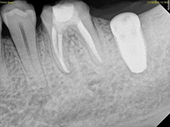 Dental Implants Case 9 - Before