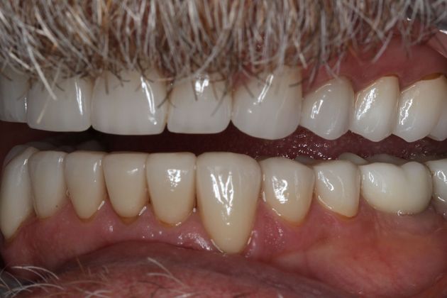 Dental Implants: Case 9 - Before