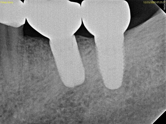Dental Implants: Case 9 - After