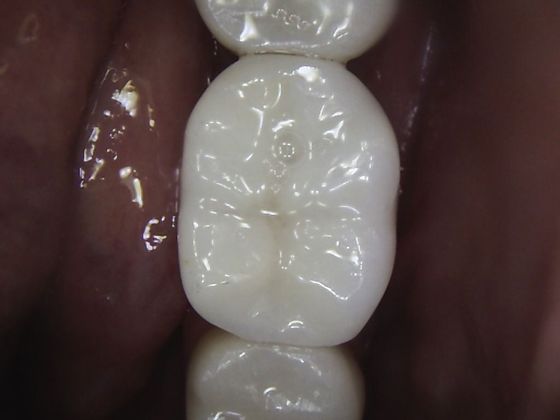 Dental Implants: Case 9 - Implant Crown