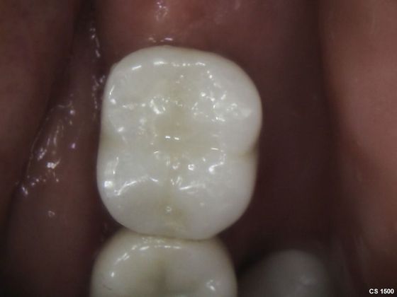 Dental Implants: Case 9 - Implant Crown