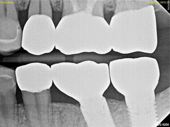 Dental Implants: Case 9