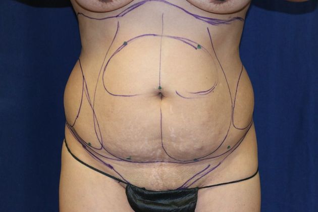 Liposuction & Safe Lipo: Case 45 - Before