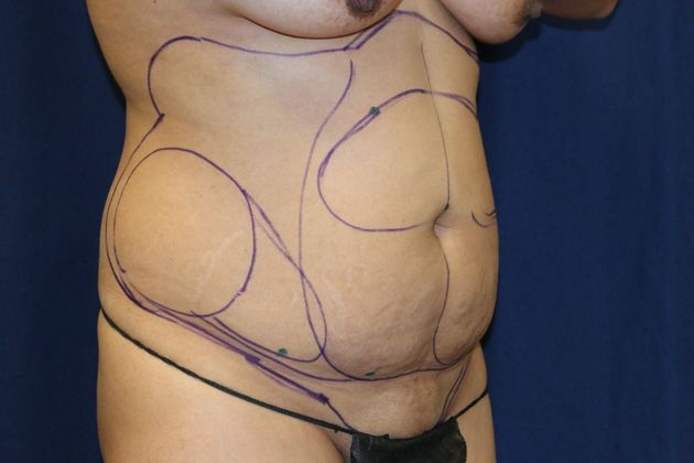 Liposuction & Safe Lipo: Case 45 - Before