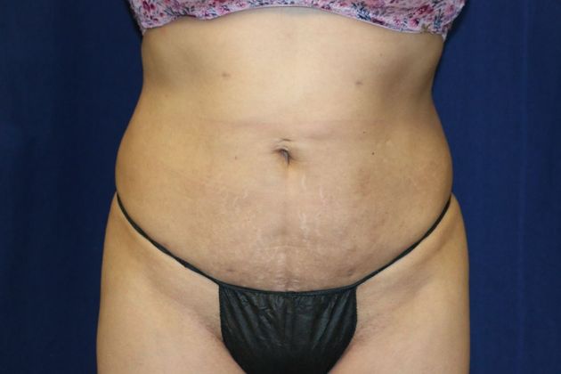 Liposuction & Safe Lipo: Case 45 - After