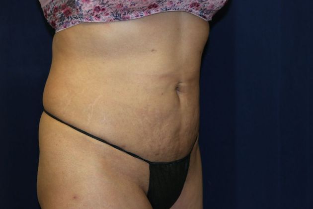 Liposuction & Safe Lipo: Case 45 - After