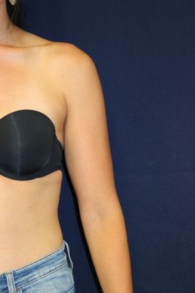 Arm Lift*/Arm Sculpting: Case 13 - Before