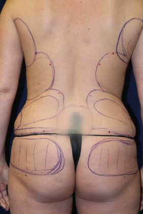 Brazilian Butt Lift : Case 10 - Before