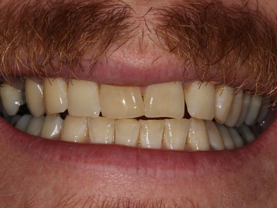 Bridges: Corner of your smile - Before