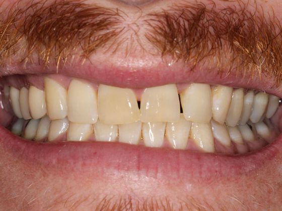 Bridges: Corner of your smile - After