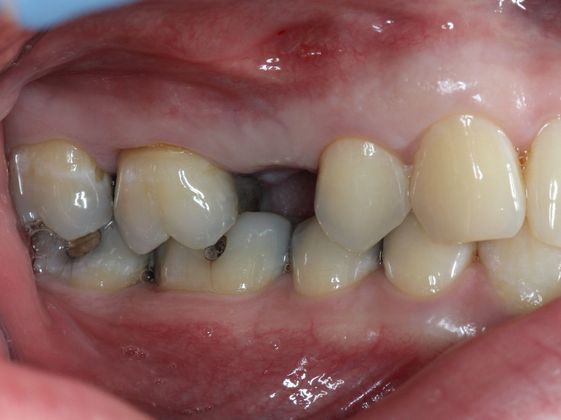 Bridges: Corner of your smile - Before