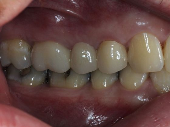 Bridges: Corner of your smile - After