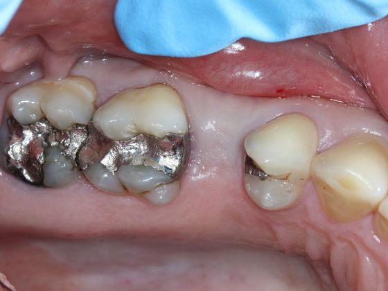 Bridges: Corner of your smile - Before