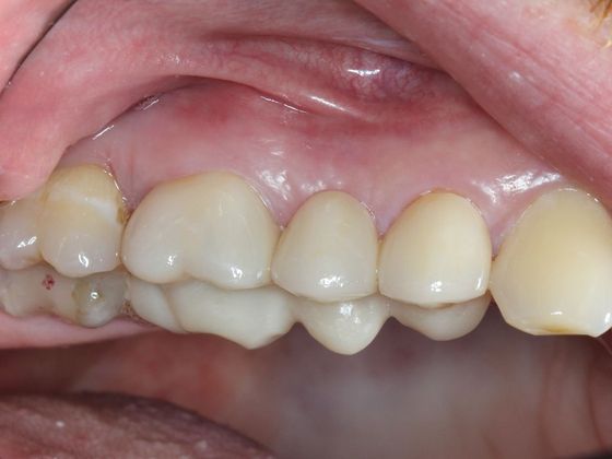 Bridges: Corner of your smile - After