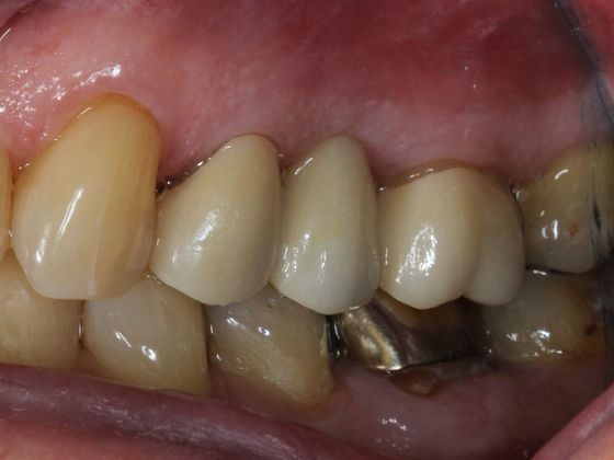 Bridges Function and Esthetics - After