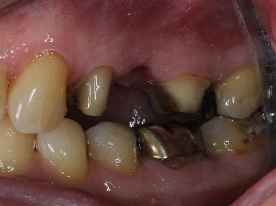 Bridges Function and Esthetics - Before