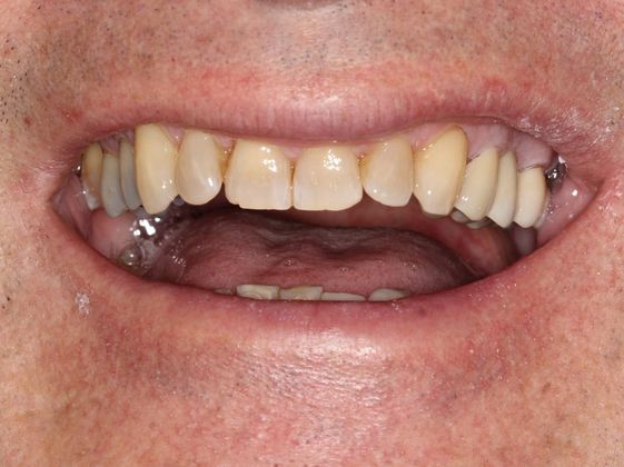 Bridges: Function and Esthetics - After