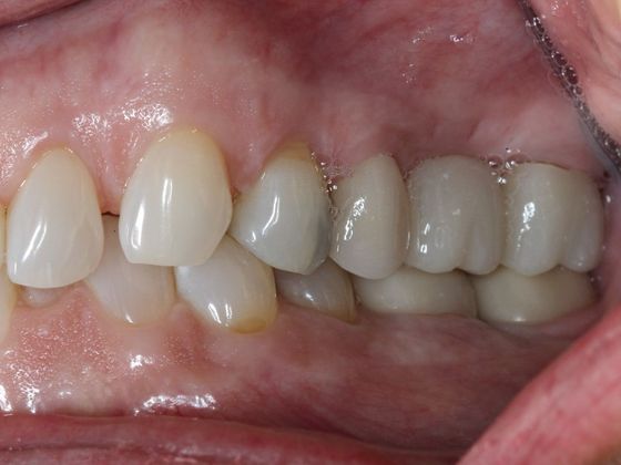 Bridges: Shadows in the corner of your smile - After