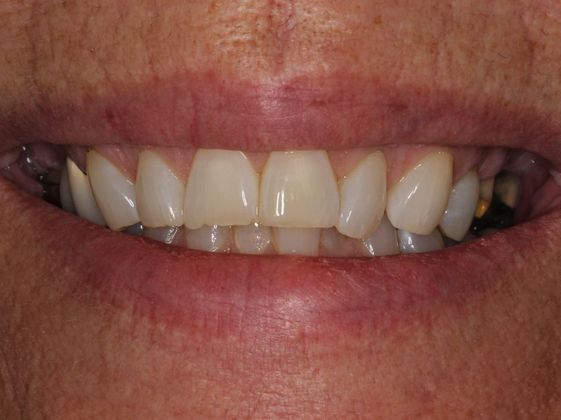 Bridges Shadows in the corner of your smile - Before