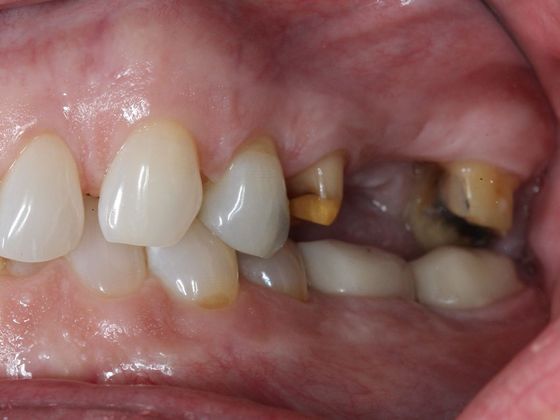 Bridges: Shadows in the corner of your smile - Before