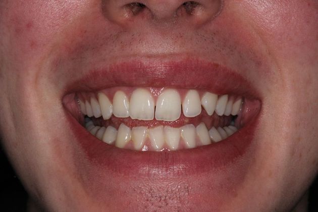 Invisalign (Clear Aligners) Details Matter - Before