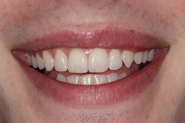 Invisalign (Clear Aligners) Details Matter - After