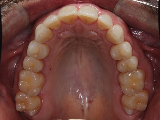 Invisalign (Clear Aligners): Lip Biting - After