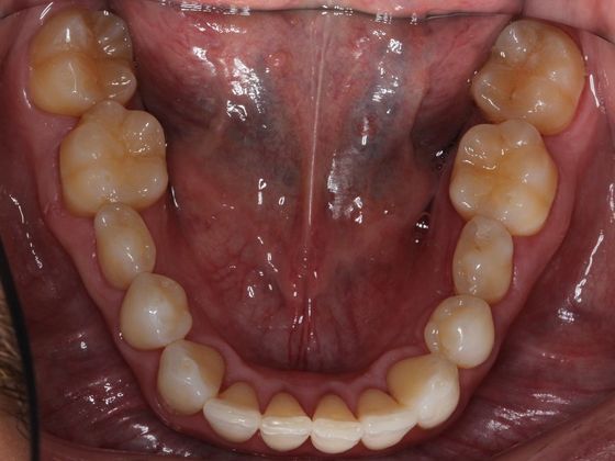 Invisalign (Clear Aligners): Lip Biting - After