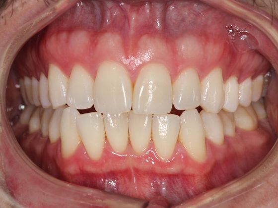 Invisalign (Clear Aligners): Lip Biting - Before