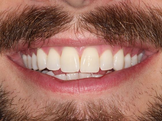 Invisalign (Clear Aligners) Lip Biting - Before